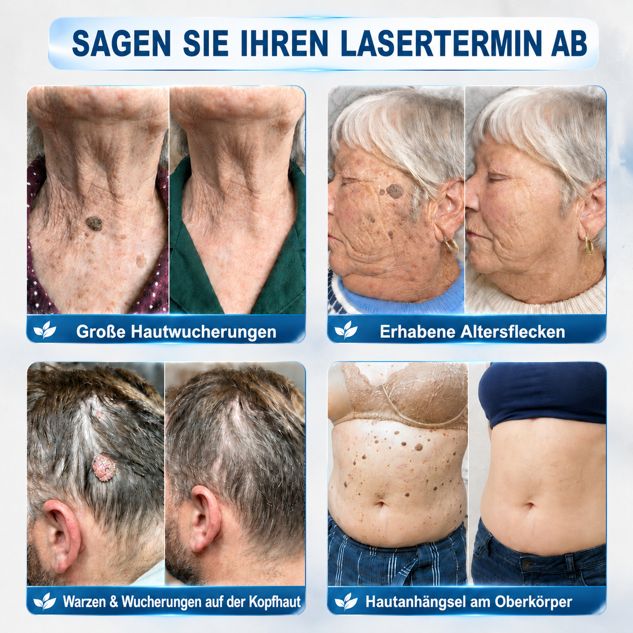 HISKIN®👩‍⚕️ 7-Tage-Hautmakel- & Hautanhängsel-Entferner Schmerzfreier Rollerball-Stift zur schonenden Entfernung von Hautanhängseln und Hautflecken – narbenfrei💛