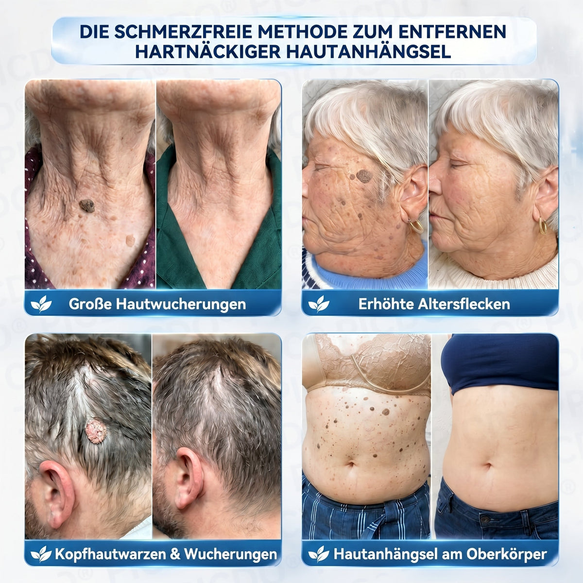 𝐏𝐢𝐜𝐝𝐨® 𝟕-𝐓𝐚𝐠𝐞 𝐇𝐚𝐮𝐭𝐚𝐧𝐡ä𝐧𝐠𝐬𝐞𝐥- & 𝐅𝐥𝐞𝐜𝐤𝐞𝐧-𝐄𝐧𝐭𝐟𝐞𝐫𝐧𝐮𝐧𝐠𝐬𝐜𝐫𝐞𝐦𝐞(𝐒𝐜𝐡𝐦𝐞𝐫𝐳𝐟𝐫𝐞𝐢𝐞 𝐅𝐨𝐫𝐦𝐞𝐥 – 𝐨𝐡𝐧𝐞 𝐍𝐚𝐫𝐛𝐞𝐧)🌟🌟🌟