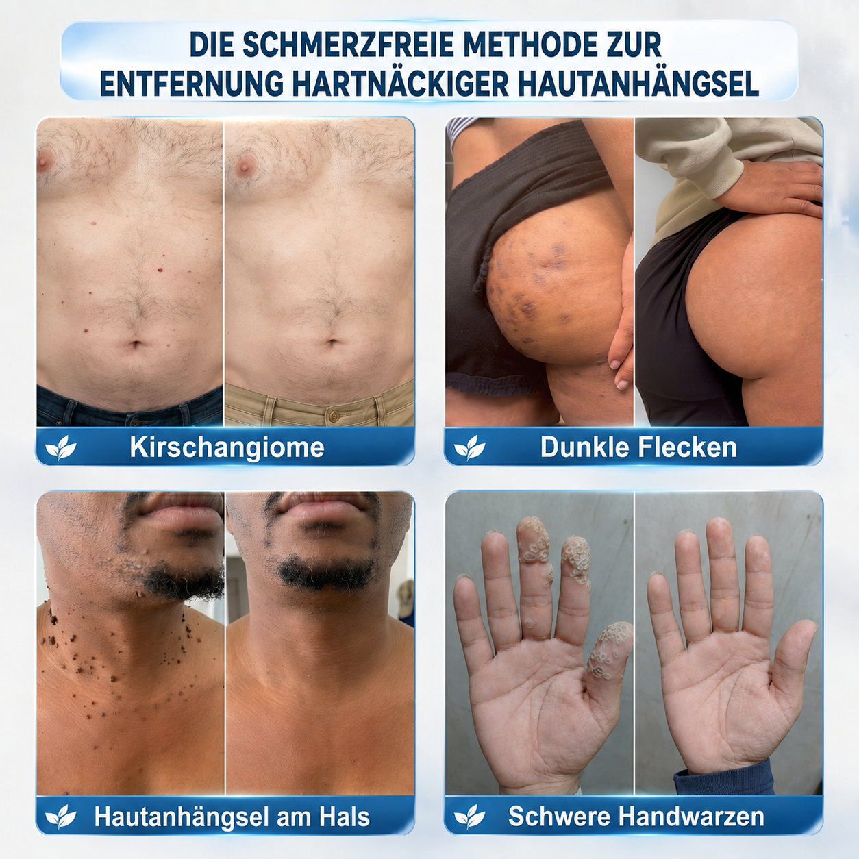 HISKIN®👩‍⚕️ 7-Tage-Hautmakel- & Hautanhängsel-Entferner Schmerzfreier Rollerball-Stift zur schonenden Entfernung von Hautanhängseln und Hautflecken – narbenfrei💛