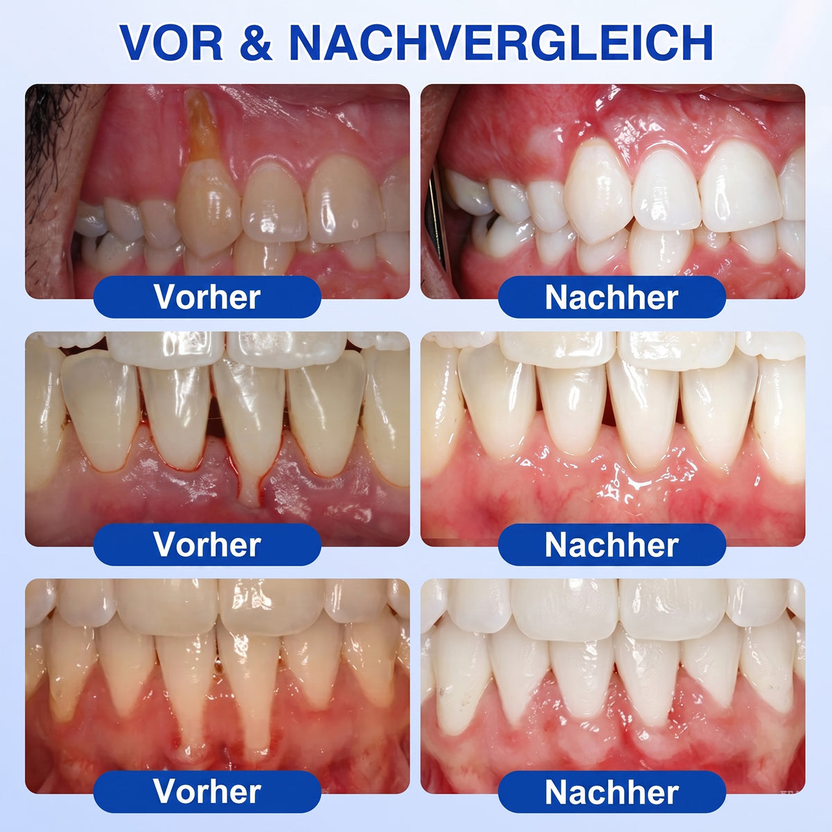 🇩🇪🏆🦷🛡️ Dr.Era® GumRevive Zahnfleisch- & Parodontalschutz-Gel🧊🧊🧊🧊🧊