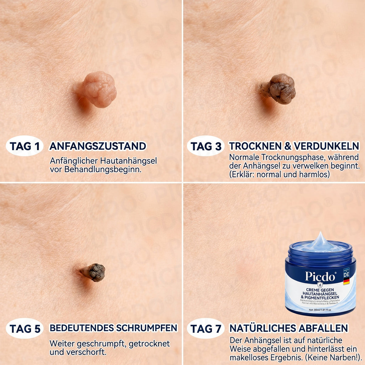 𝐏𝐢𝐜𝐝𝐨® 𝟕-𝐓𝐚𝐠𝐞 𝐇𝐚𝐮𝐭𝐚𝐧𝐡ä𝐧𝐠𝐬𝐞𝐥- & 𝐅𝐥𝐞𝐜𝐤𝐞𝐧-𝐄𝐧𝐭𝐟𝐞𝐫𝐧𝐮𝐧𝐠𝐬𝐜𝐫𝐞𝐦𝐞(𝐒𝐜𝐡𝐦𝐞𝐫𝐳𝐟𝐫𝐞𝐢𝐞 𝐅𝐨𝐫𝐦𝐞𝐥 – 𝐨𝐡𝐧𝐞 𝐍𝐚𝐫𝐛𝐞𝐧)🌟🌟🌟